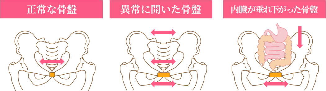 骨盤の歪みの３タイプ